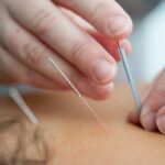 acupuncture needles inserted into skin
